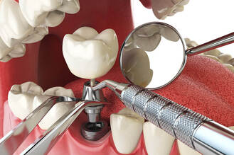 A dental implant is being installed into the gum where a tooth is missing. Several dental tools, including a dental mirror, probe, and forceps, are visible. The image shows the metal post being inserted into the jawbone and the crown being attached to the post.