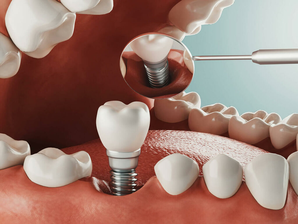 Illustration showing a dental implant being placed