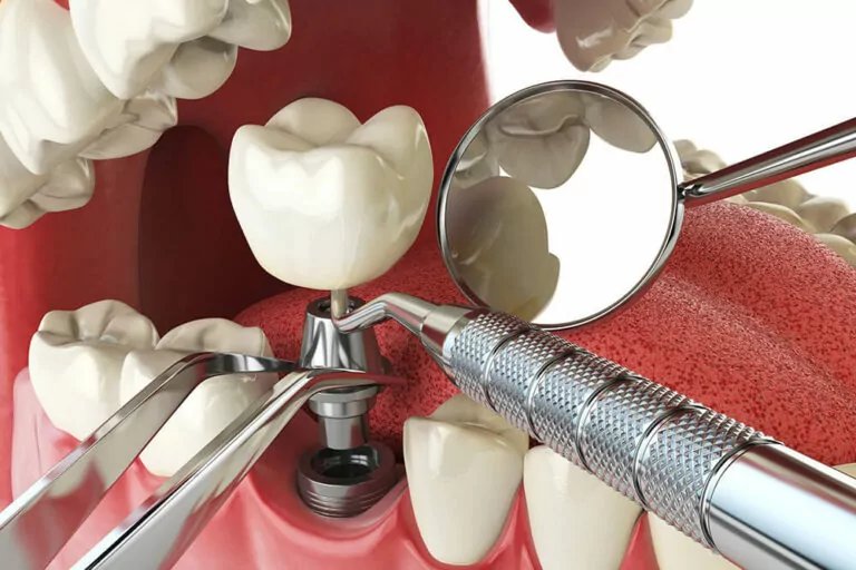 A dental implant is being installed into the gum where a tooth is missing. Several dental tools, including a dental mirror, probe, and forceps, are visible. The image shows the metal post being inserted into the jawbone and the crown being attached to the post.