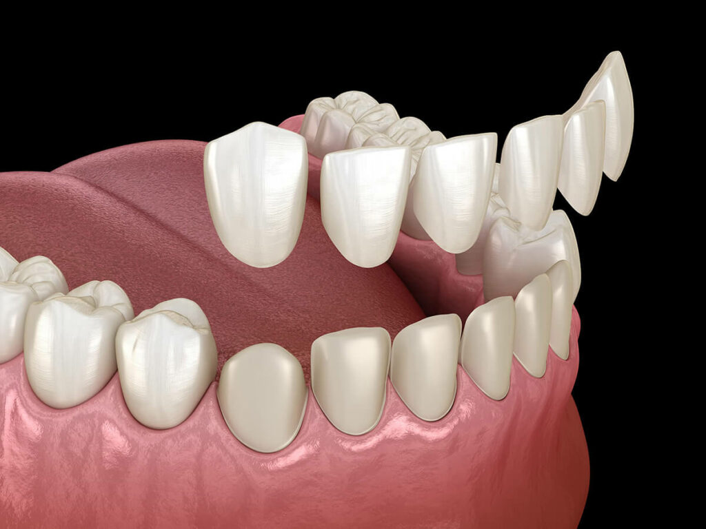 Illustration showing dental veneers fitting over teeth