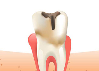 Illustration showing a tooth with visible decay at the top, indicated by a dark brown area, and red gum tissue surrounding the tooth. The image demonstrates the effects of dental caries.