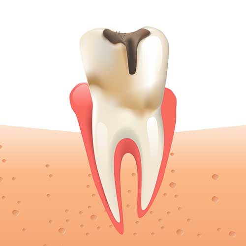 Illustration showing a decayed tooth