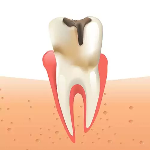 Illustration showing a tooth with visible decay at the top, indicated by a dark brown area, and red gum tissue surrounding the tooth. The image demonstrates the effects of dental caries.