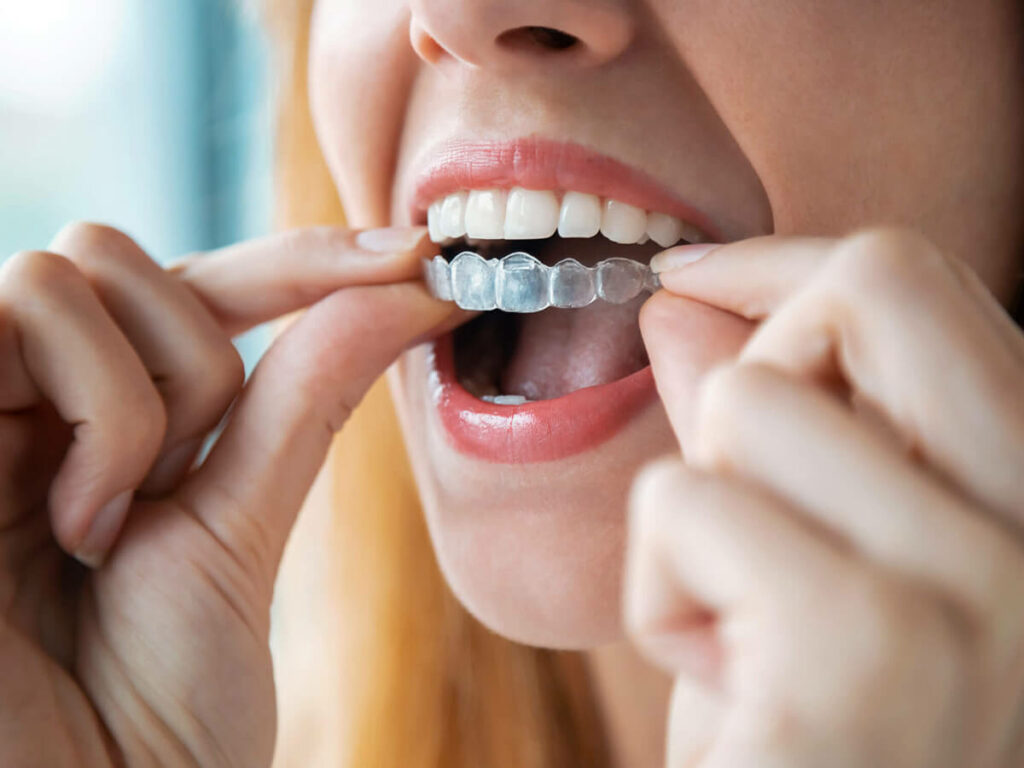 Woman fitting Invisalign clear aligner onto teeth