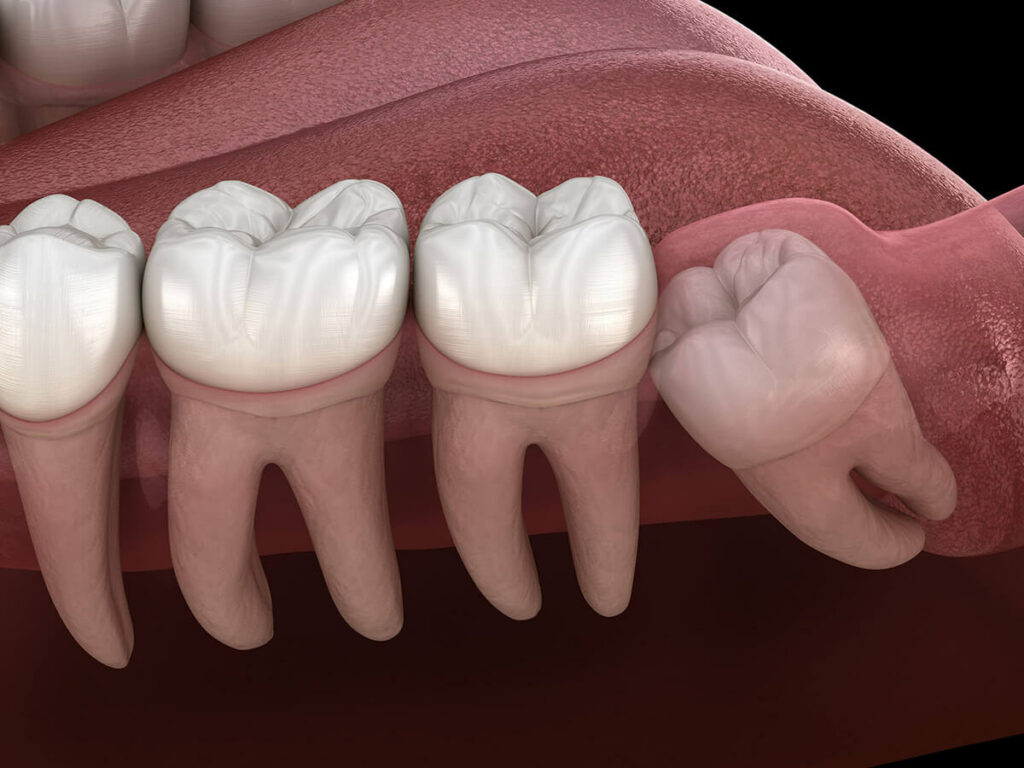 3D Illustration showing an impacted wisdom tooth
