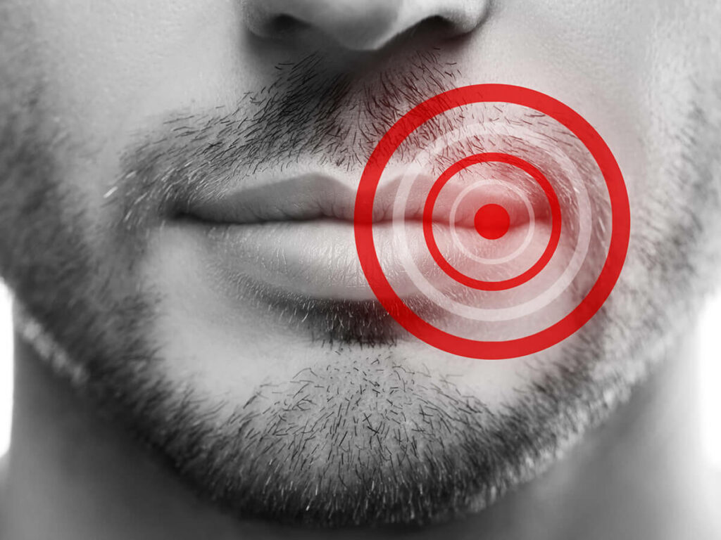 Illustration Showing Cold Sore Forming on Man's Mouth